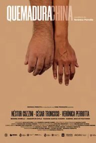 Quemadura china